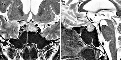 Injury to the Extrasellar Portion of the Internal Carotid Artery during Endoscopic Transsphenoidal Surgery: A Case Report